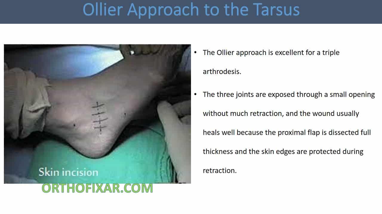  Ollier Approach to Sinus Tarsi 