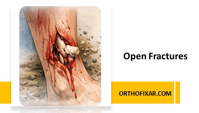 Open Fractures
