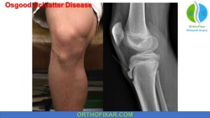 Osgood Schlatter Disease - Full Detailed | OrthoFixar 2024