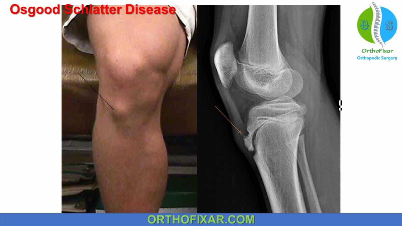 Osgood Schlatter Disease - Full Detailed | OrthoFixar 2024