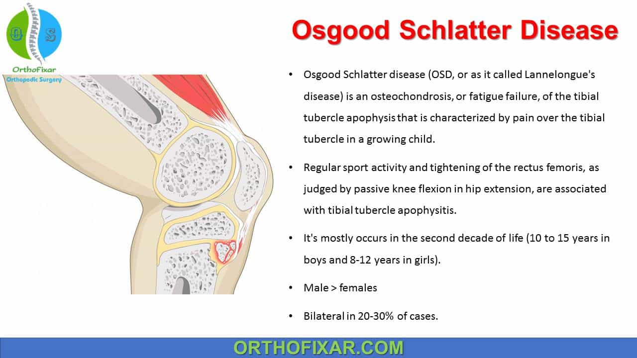 Osgood Schlatter Disease Nhs Osgood Schlatter Disease Nhs