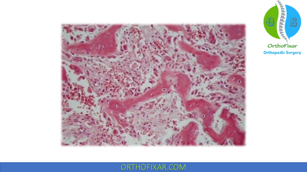 Osteoblastoma histology