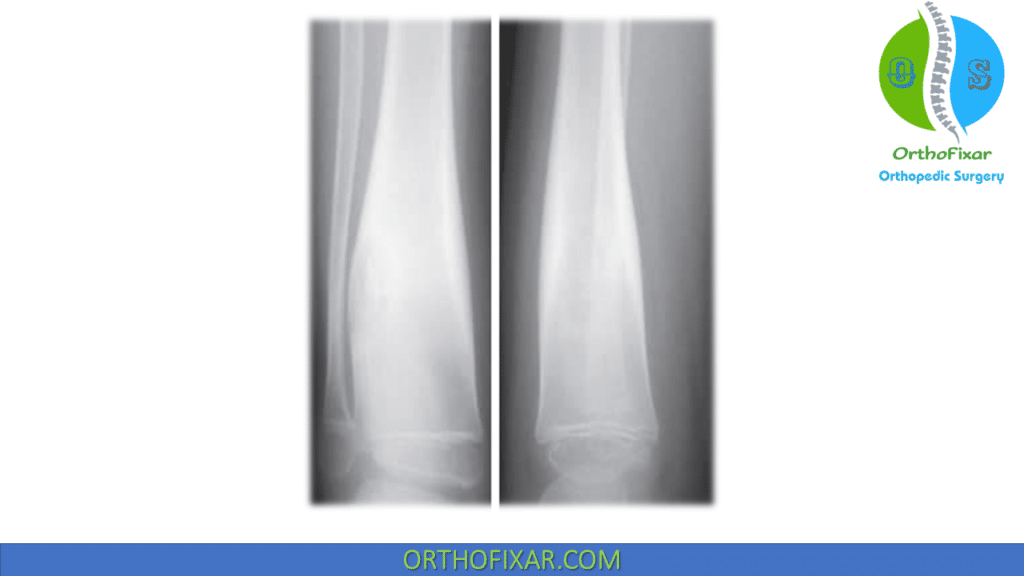 Osteoblastoma in the Leg