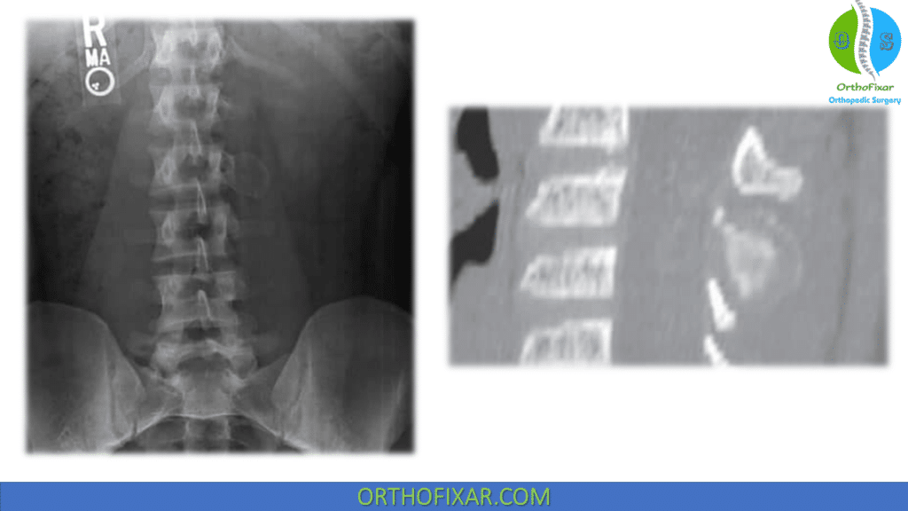 Osteoblastoma spine in Left L2 transverse process