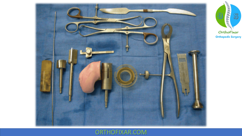 Osteochondral Allograft Transplantation