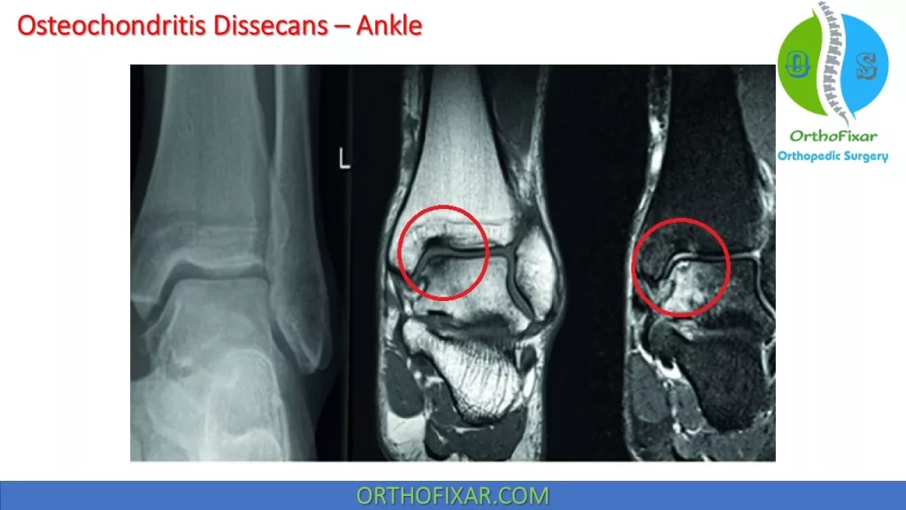 Osteochondritis Dissecans Ankle