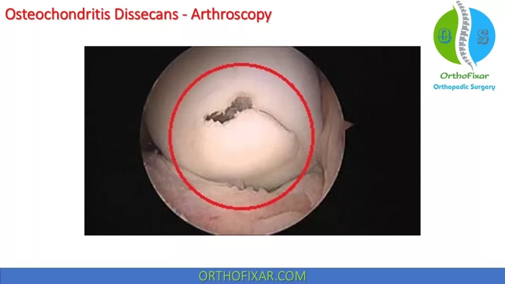 Osteochondritis Dissecans Arthroscopy