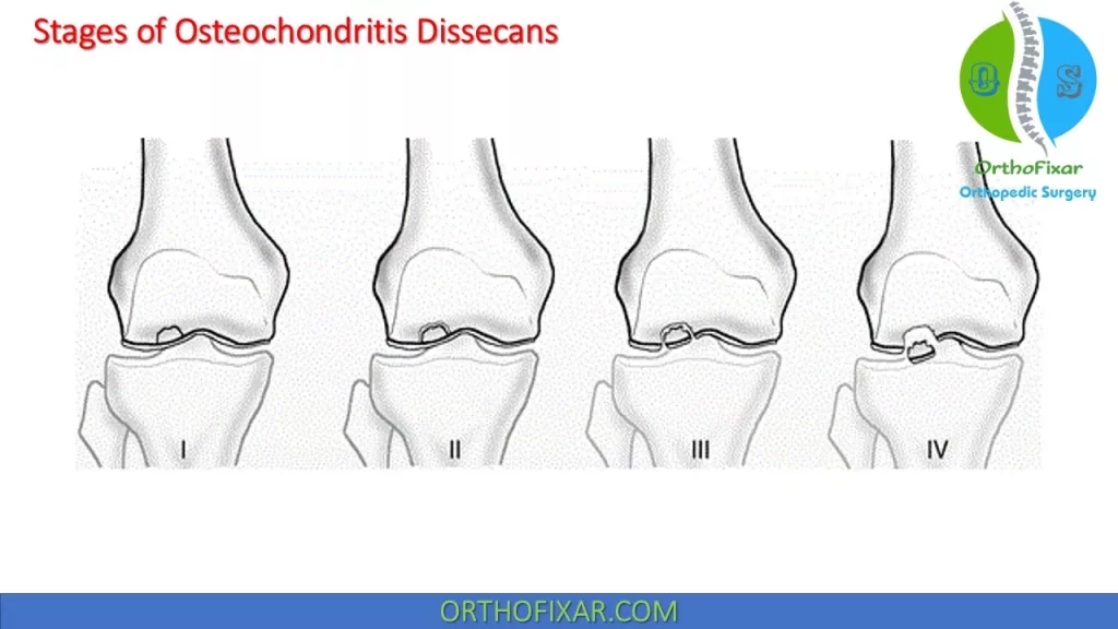 Osteochondritis Dissecans stages