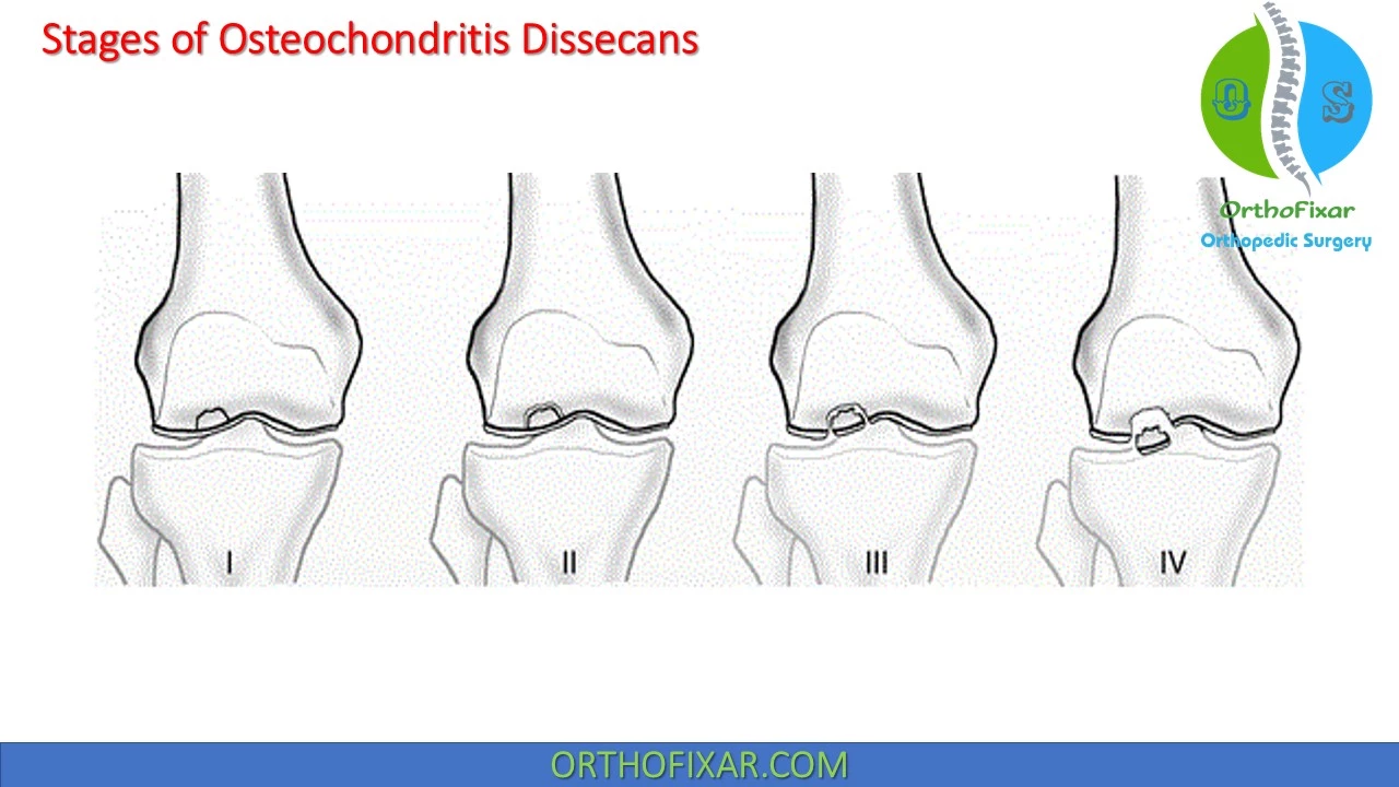 osteochondritis dissecans stages csípőízületi arthrosis 1 fokozatú kezelés