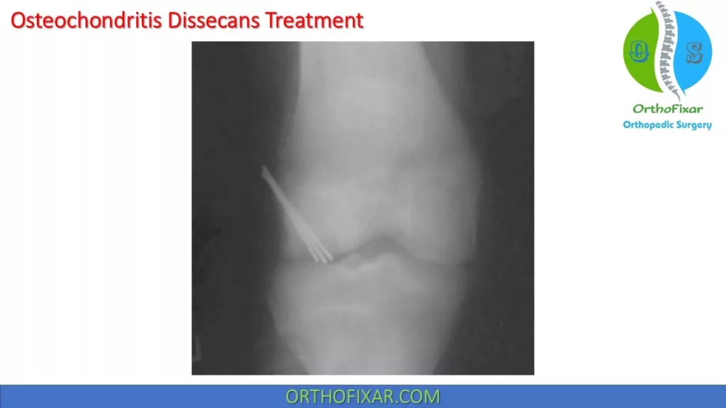 Osteochondritis Dissecans treatment 2