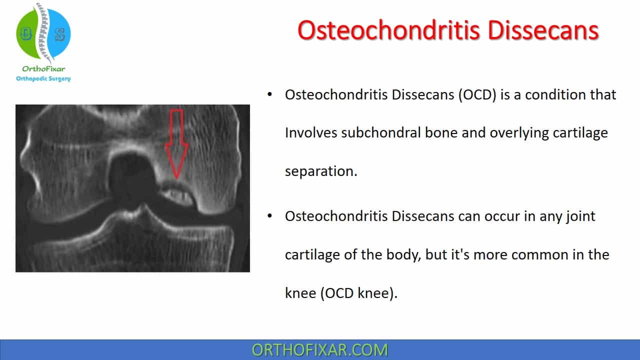 osteochondritis dissecans stages)