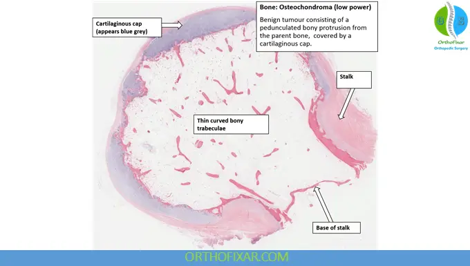 Osteochondroma: Comprehensive Medical Overview 7 Osteochondroma Histopathology