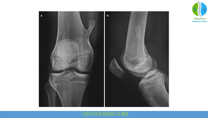 Osteochondroma: Comprehensive Medical Overview 5 Osteochondroma femur