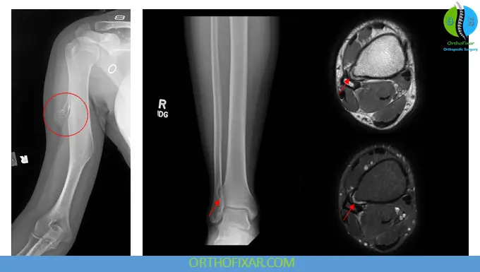 Osteochondroma: Comprehensive Medical Overview 6 Osteochondroma imaging