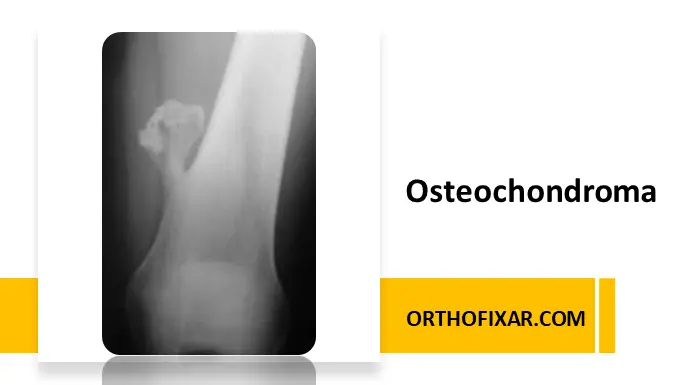 Osteochondroma