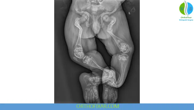 Osteogenesis Imperfecta xray