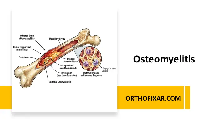 Osteomyelitis
