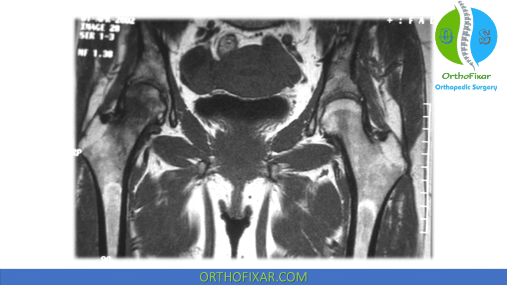 Osteonecrosis of the Hip mri