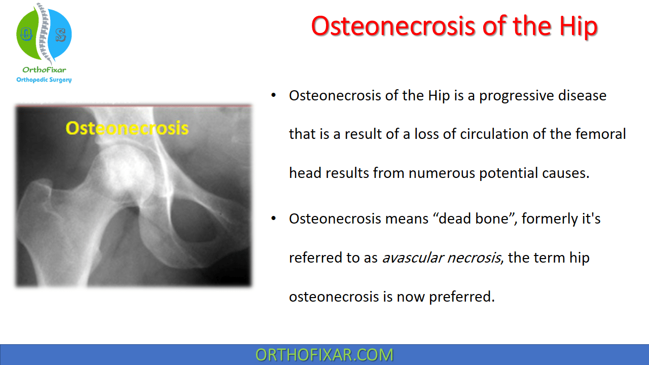 Osteonecrosis of the Hip