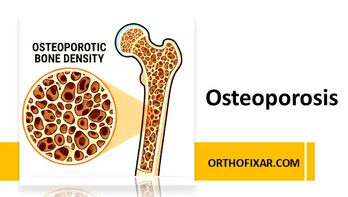 Osteoporosis