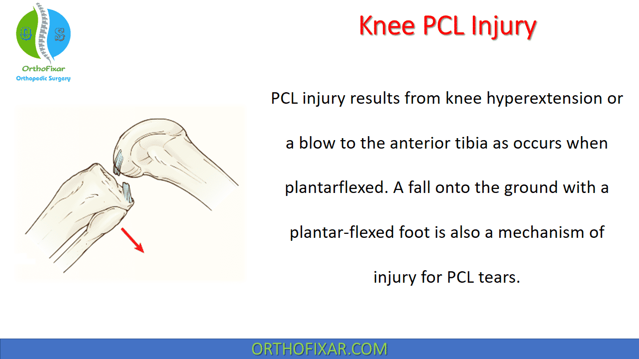  Knee PCL Injury 