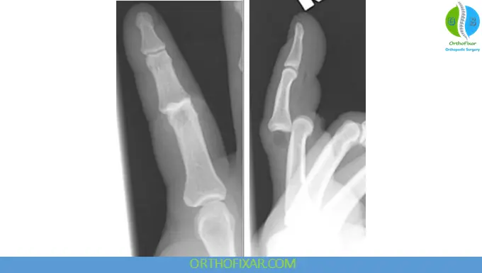 PIP Dorsal Dislocation