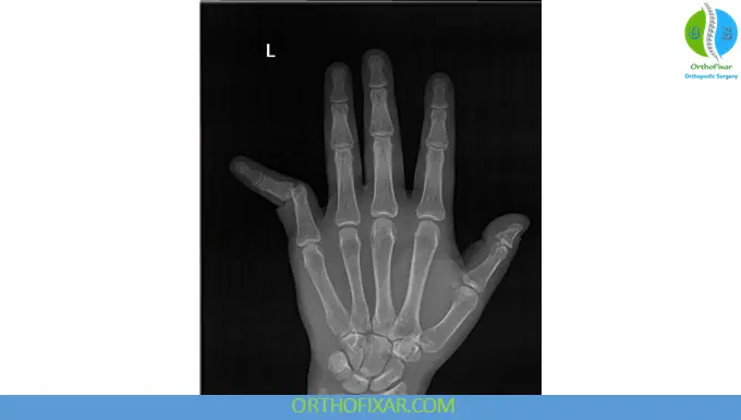 PIP Lateral Dislocation