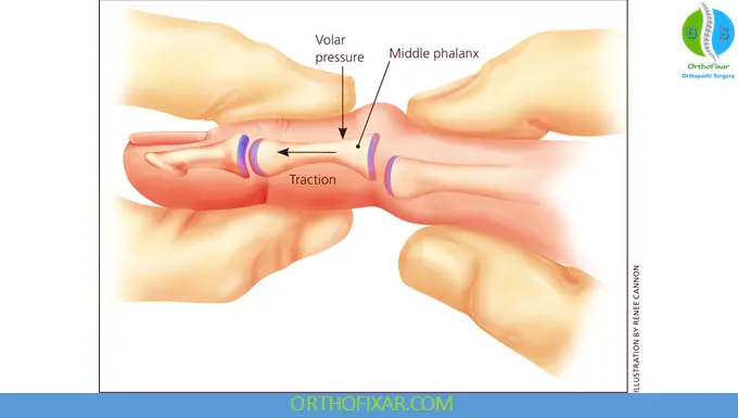 PIP dislocation reduction