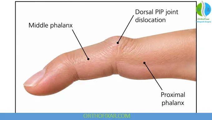 PIP dislocation