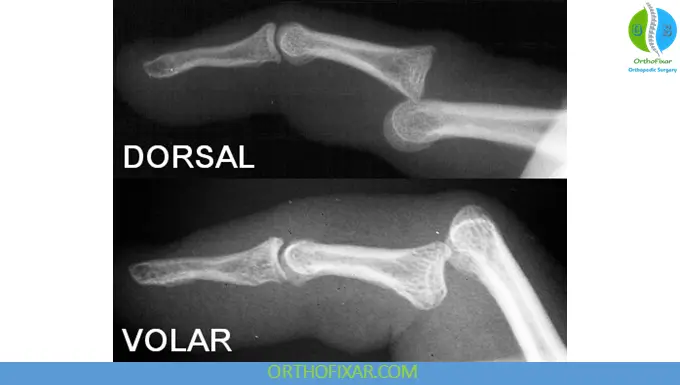 PIP volar dislocation vs dorsal dislocation