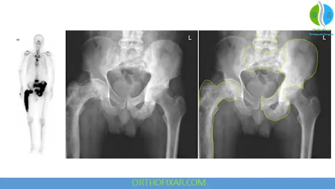 Paget’s Disease of Bone: Symptoms, Causes, Diagnosis & Treatment 7 Paget’s Disease of Bone pelvic