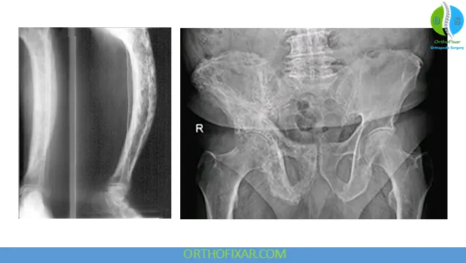 Paget’s Disease of Bone: Symptoms, Causes, Diagnosis & Treatment 6 Paget’s Disease of Bone xray