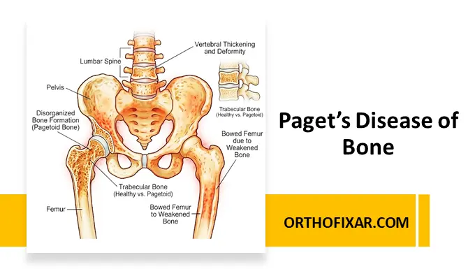 Paget’s Disease of Bone