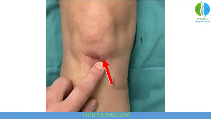 Palpable infrapatellar defect - Patellar Tendon Rupture