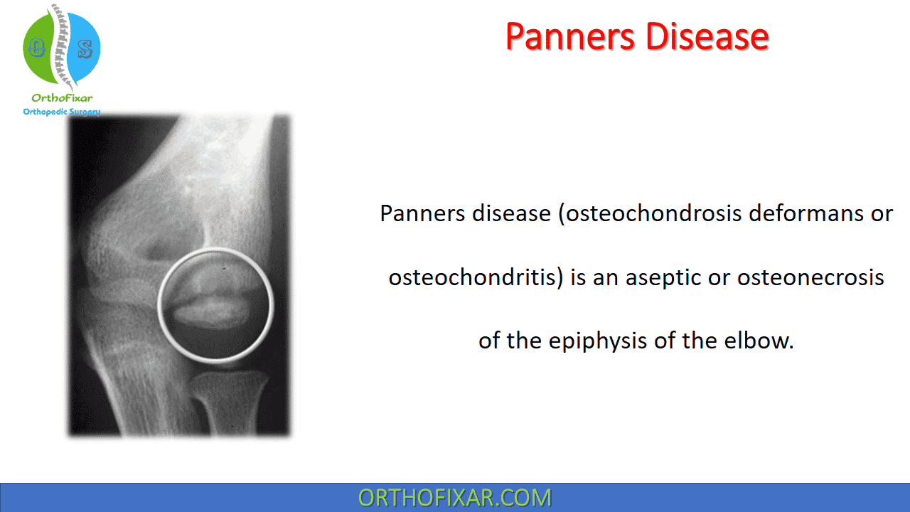  Panners Disease 