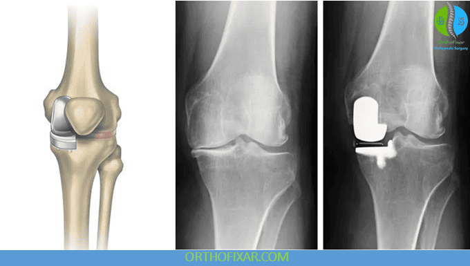 Partial vs Total Knee Replacement: Which Is Appropriate? 4 Partial Knee Replacement