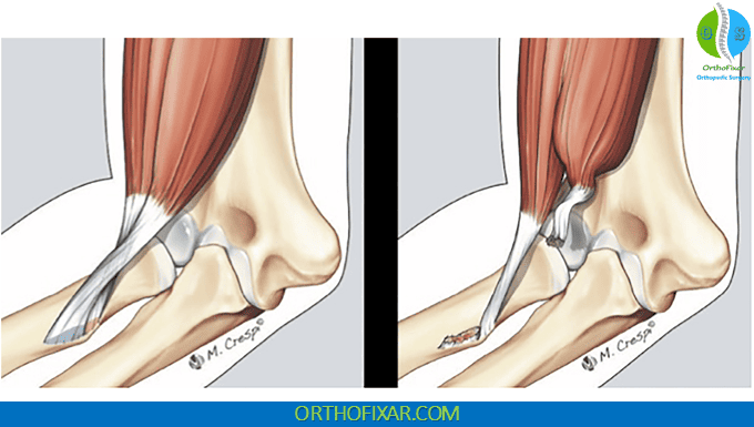 TILT Sign for Partial Tear of Distal Biceps Tendon 1 Partial Tear of Distal Biceps Tendon
