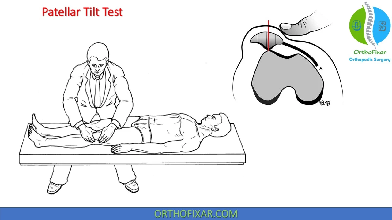 Talar Tilt Test  OrthoFixar 2023