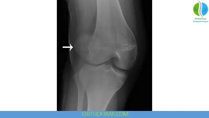 Patellar Dislocation xray
