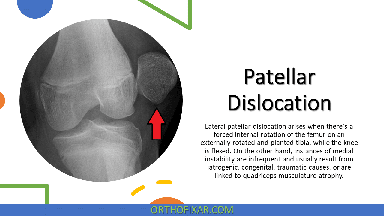  Patellar Dislocation 
