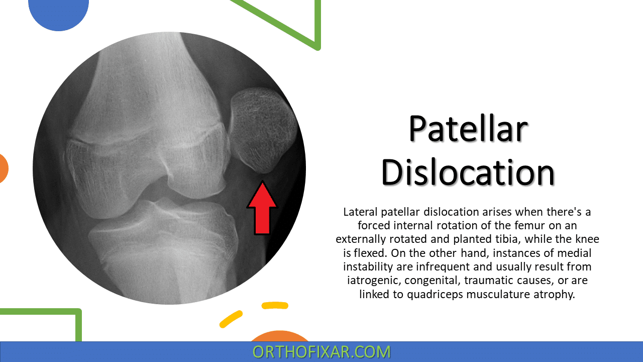 knee patellar dislocation x ray