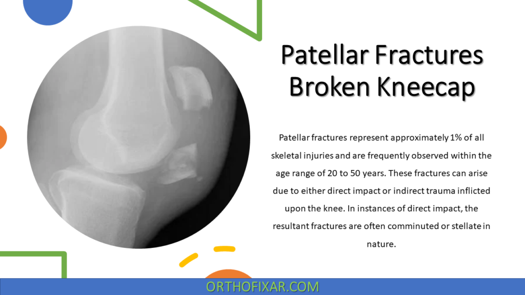 Patellar Fractures | Broken Kneecap 8 Patellar Fractures