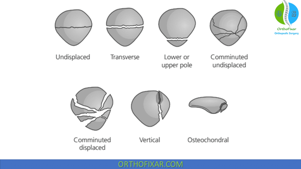 Patellar Fractures Classification
