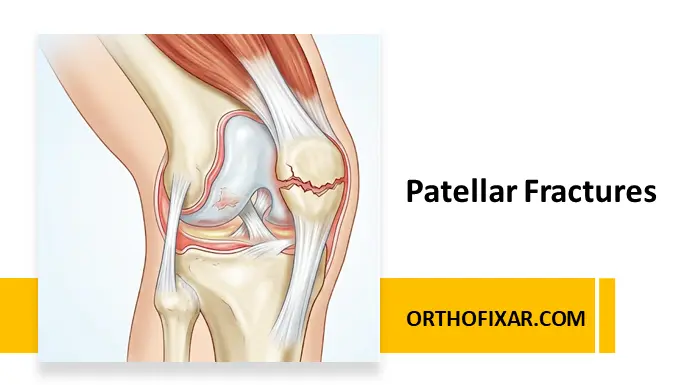 Patellar Fractures - Broken Kneecap