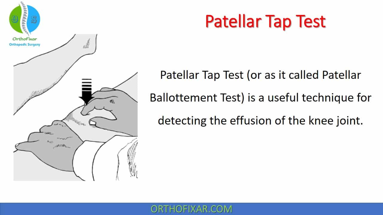 Patellar Tap Test 2024 OrthoFixar