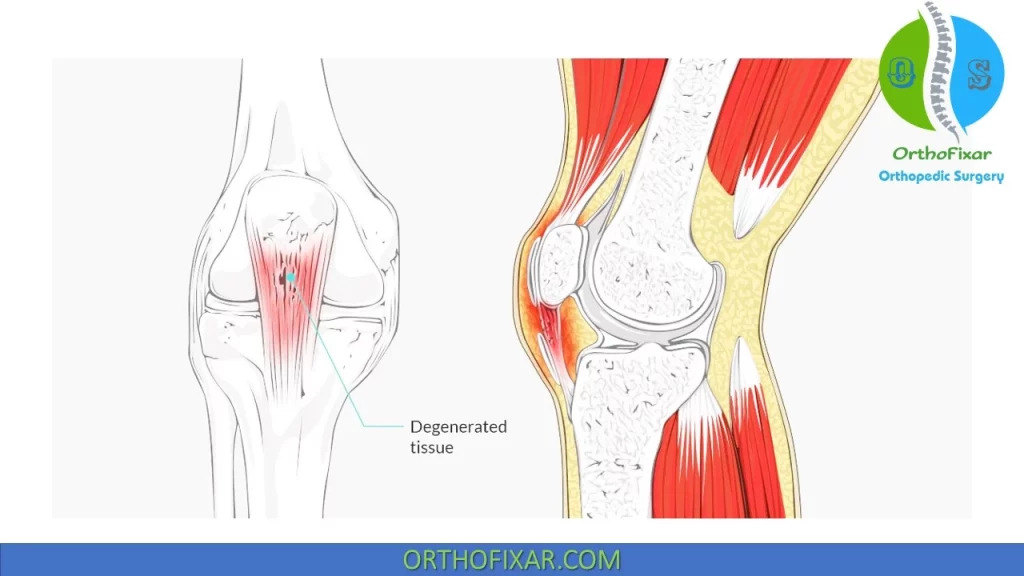 Patellar Tendinitis - jumper's knee
