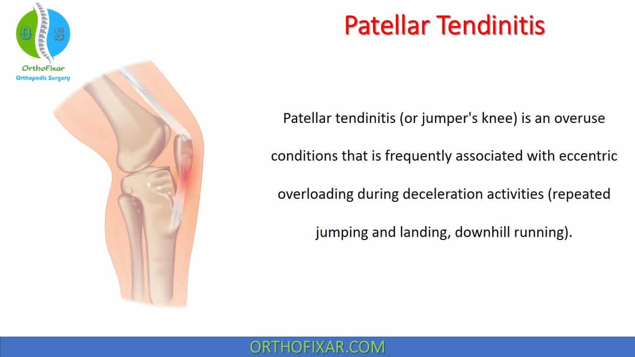  Patellar Tendinitis (Jumper’s knee) 