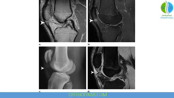 Patellar Tendon Rupture imaging