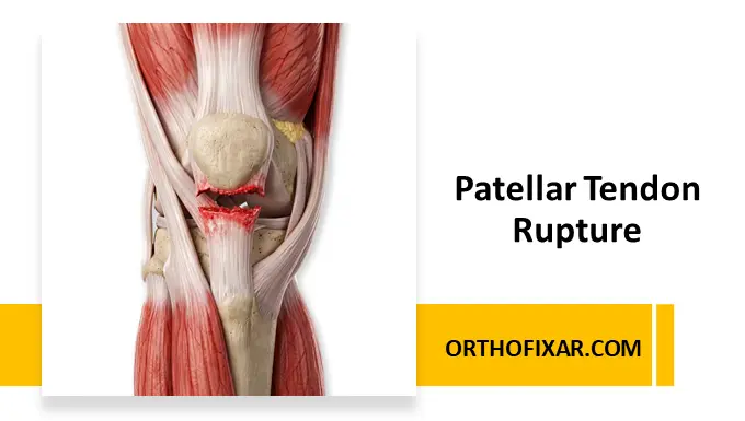 Patellar Tendon Rupture