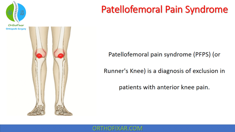 Patellofemoral Pain Syndrome